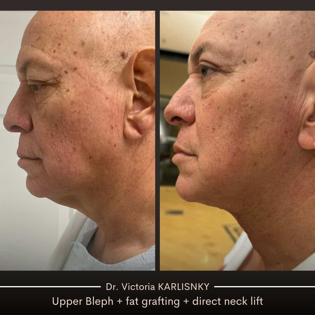 Side-by-side before and after images of a male patient showing improved neck and jawline definition, smoother skin, and rejuvenated eye area following facelift, neck lift, and upper blepharoplasty procedures.