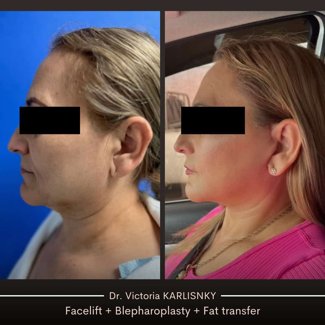 Side-by-side before and after images showing a woman's profile with visible improvements in jawline definition, neck smoothness, and midface volume following facelift and facial rejuvenation procedures