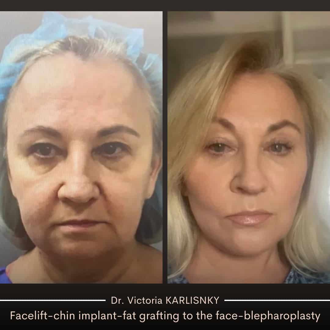 Before and after images of a female patient showing significant facial rejuvenation following facelift, eyelid surgery, chin implant, and facial fat grafting, with improved skin tightness, restored volume, and smoother facial contours