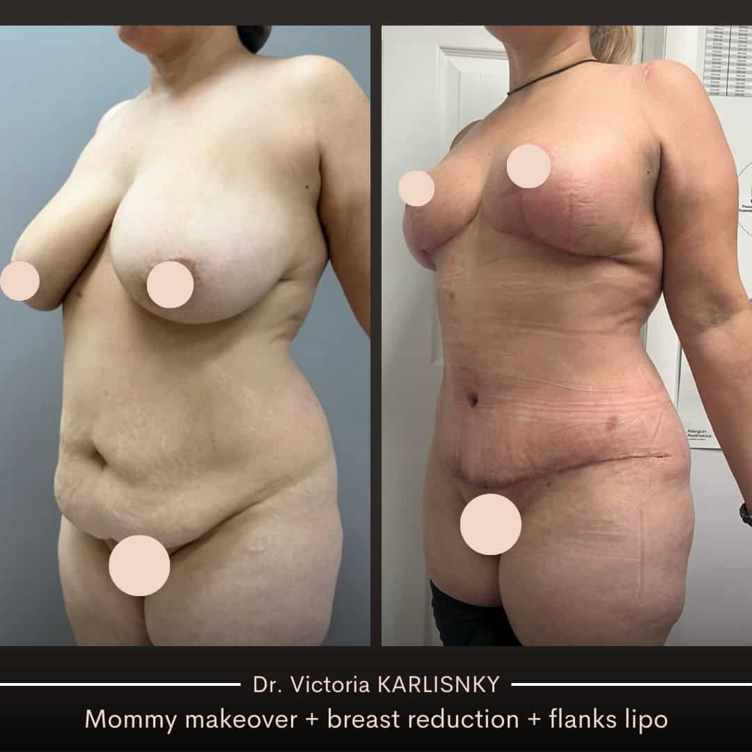 Side-by-side before and after images of a woman showing improved breast contour, flatter abdomen, and slimmer waist following a mommy makeover including breast reduction, tummy tuck, and liposuction, viewed from an oblique angle.