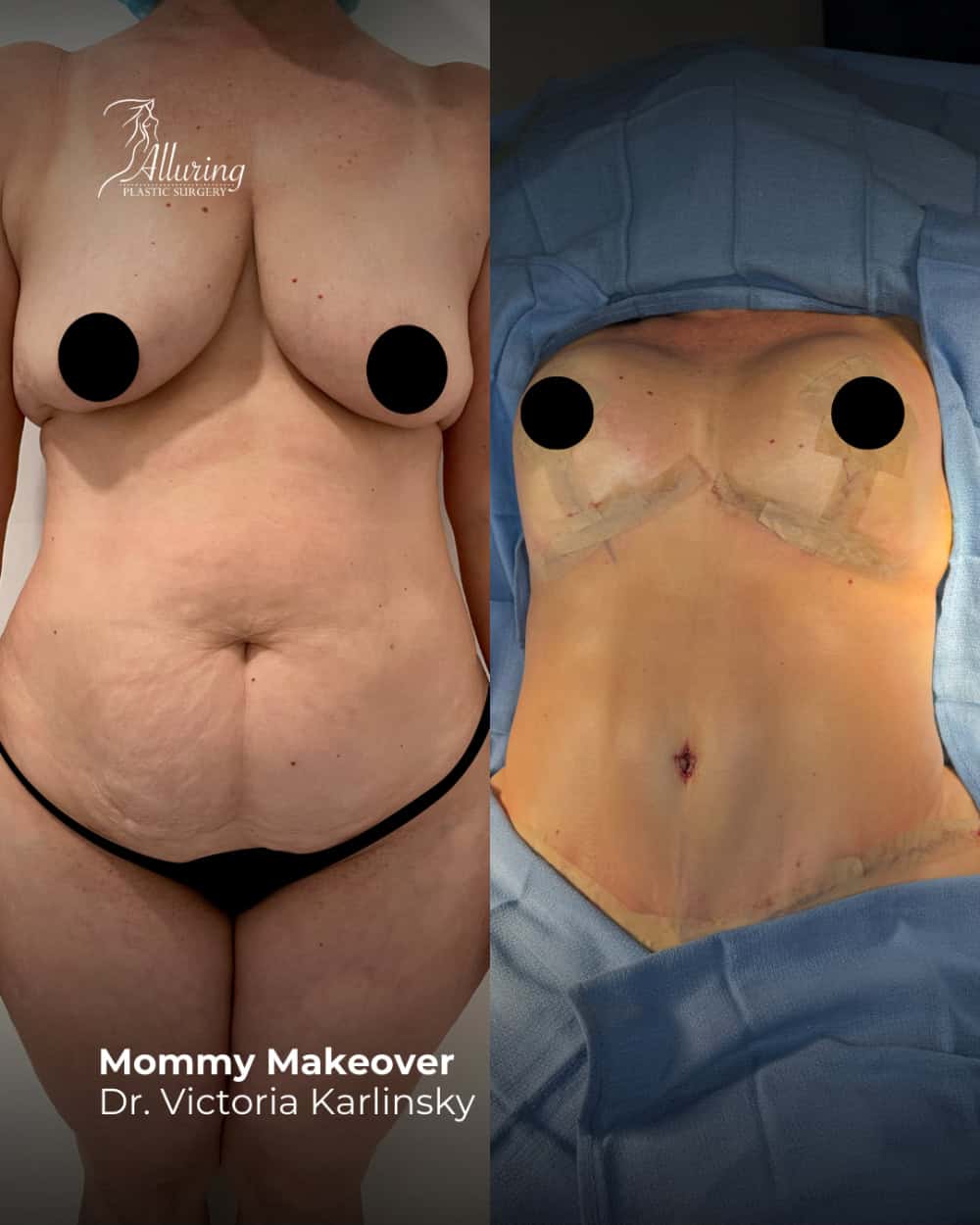 Side-by-side before and after images of a mommy makeover showing frontal views of the breasts and abdomen, with post-operative results including lifted breasts, a flatter abdomen, and visible surgical dressings.