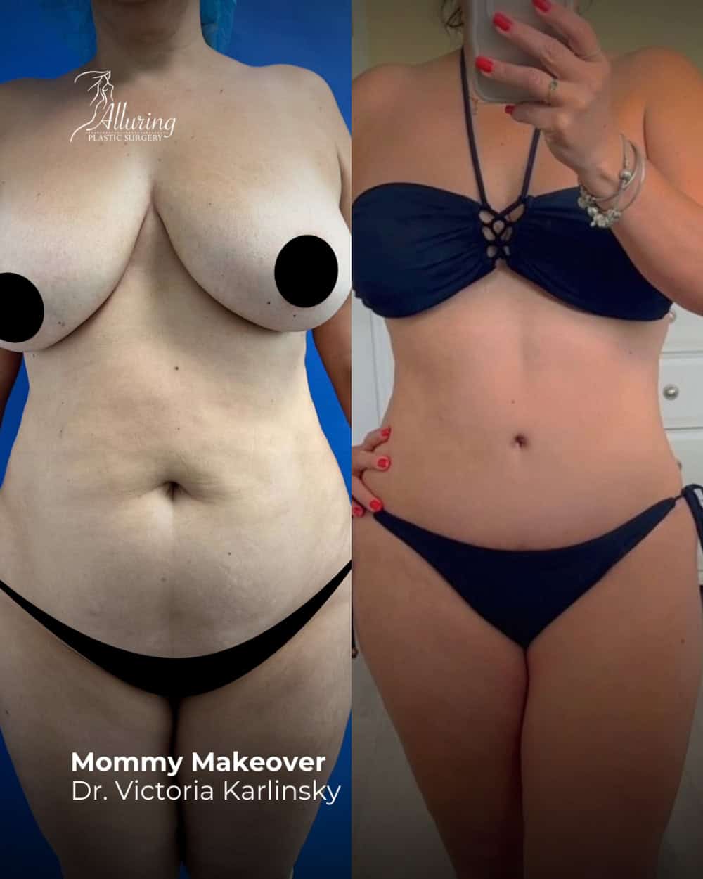 Side-by-side before and after comparison of a woman’s torso showing mommy makeover results, with improved breast shape, tighter abdominal skin, and enhanced body contour in a frontal view