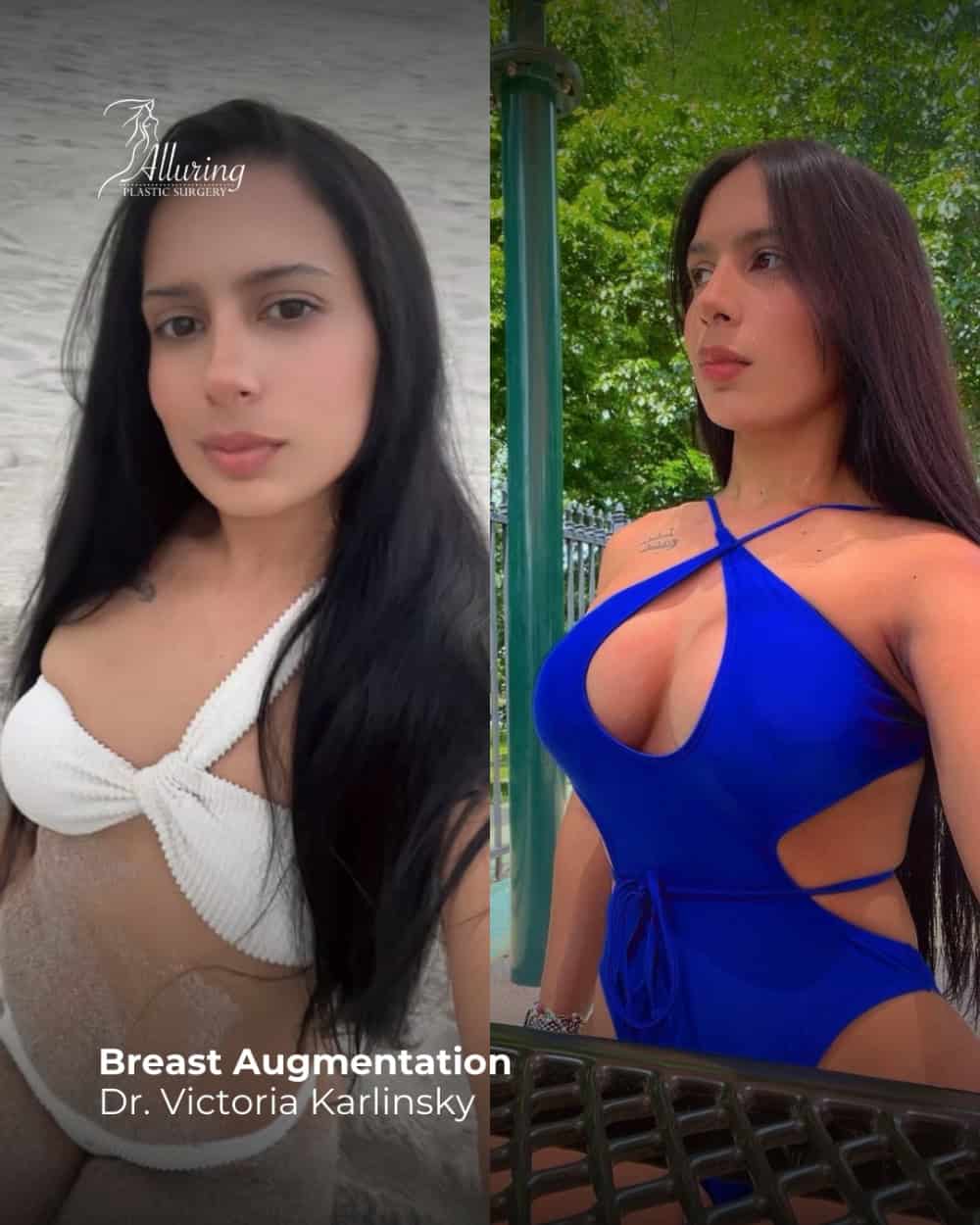 Side-by-side before and after images of a woman in swimsuits outdoors, showing fuller, more contoured breasts following breast augmentation surgery in Miami