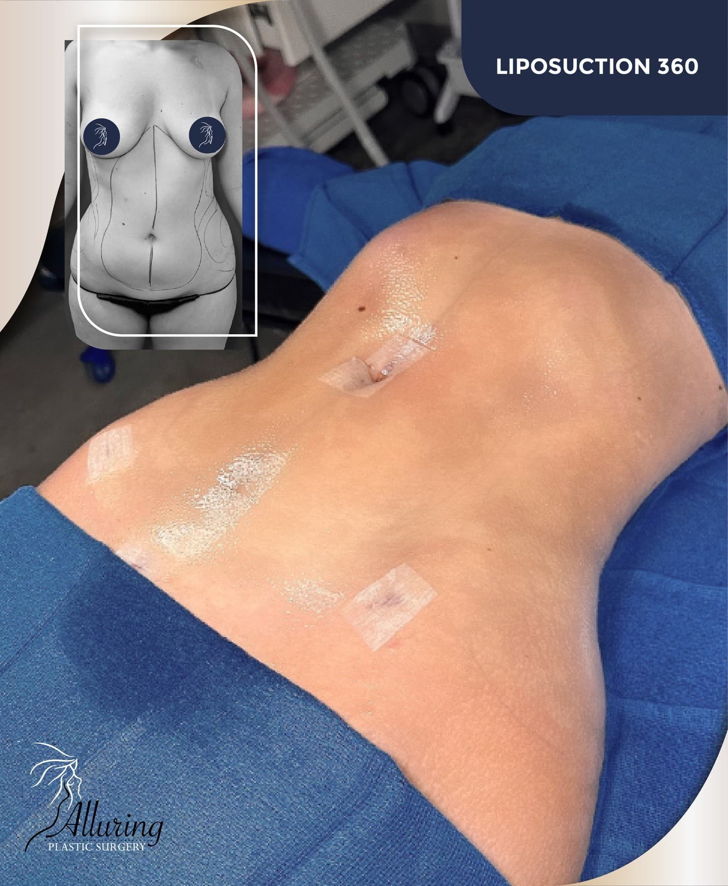 Side-by-side before and after photos of a female patient showing marked areas for liposuction and immediate post-operative results with smooth abdomen and flanks, adhesive dressings visible on midsection.
