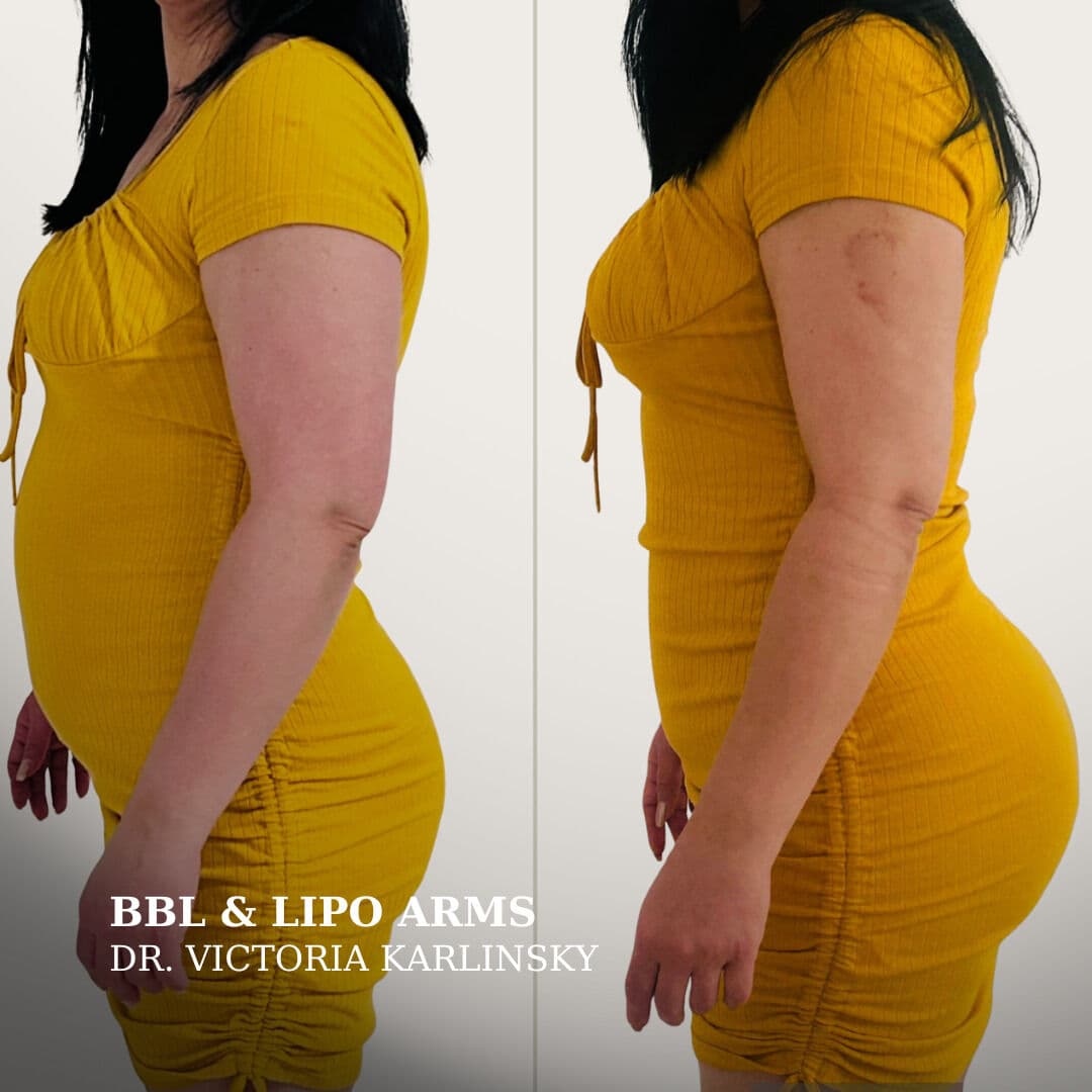 Side-by-side before and after image of a woman in a yellow dress, showing profile view of body contouring results with enhanced waist, flatter abdomen, fuller buttocks, and slimmer arms after BBL and arm liposuction