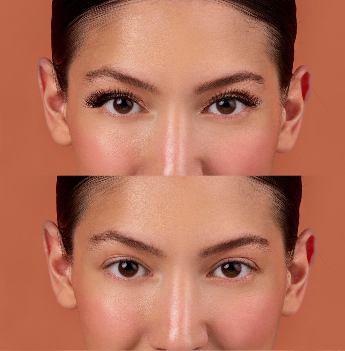 Blepharoplasty (Eyelid Surgery) Miami