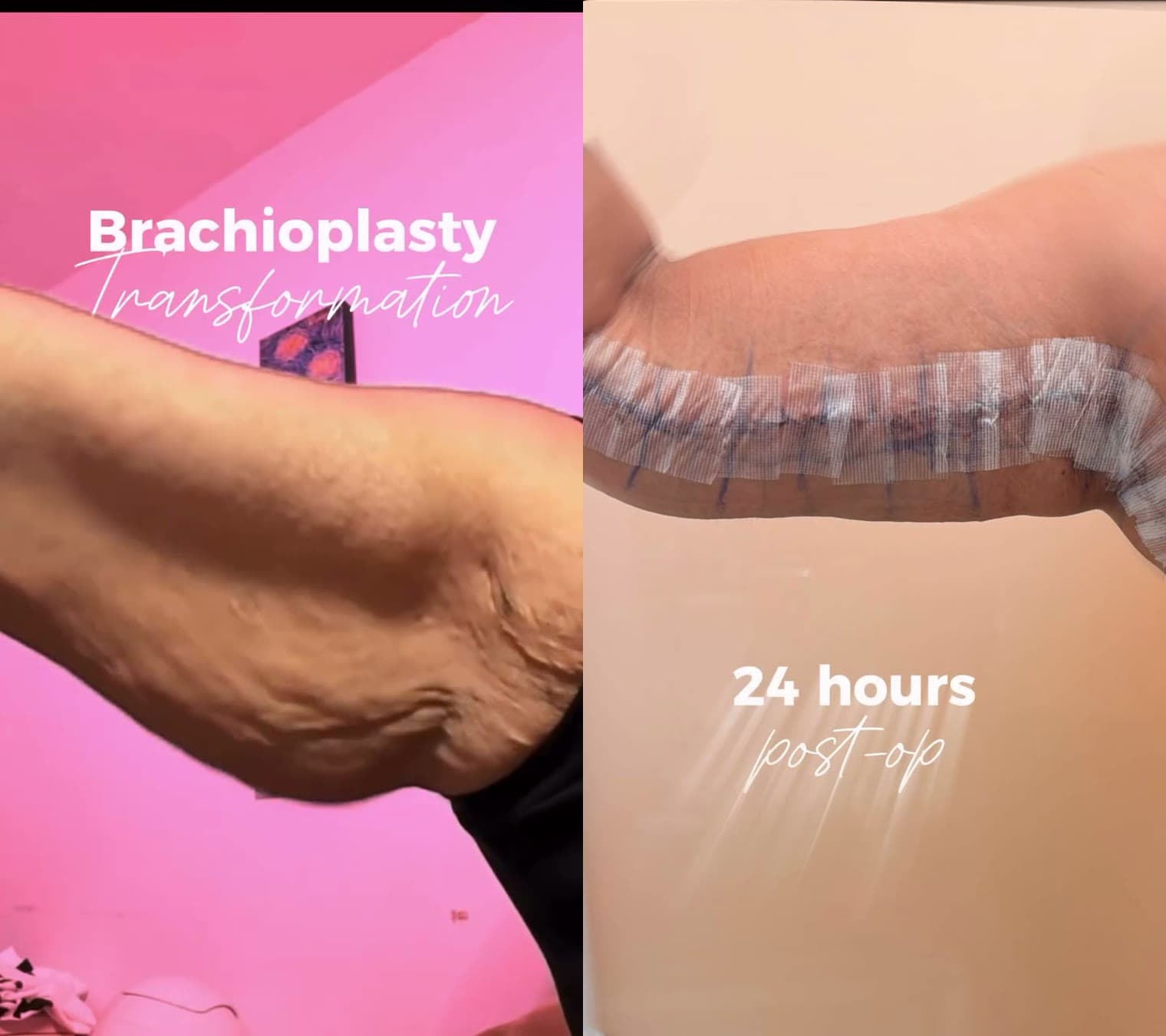 Arm Lift before and after 24 hours post-op: the patient before surgery and after surgery, Alluring Plastic Surgery, Miami