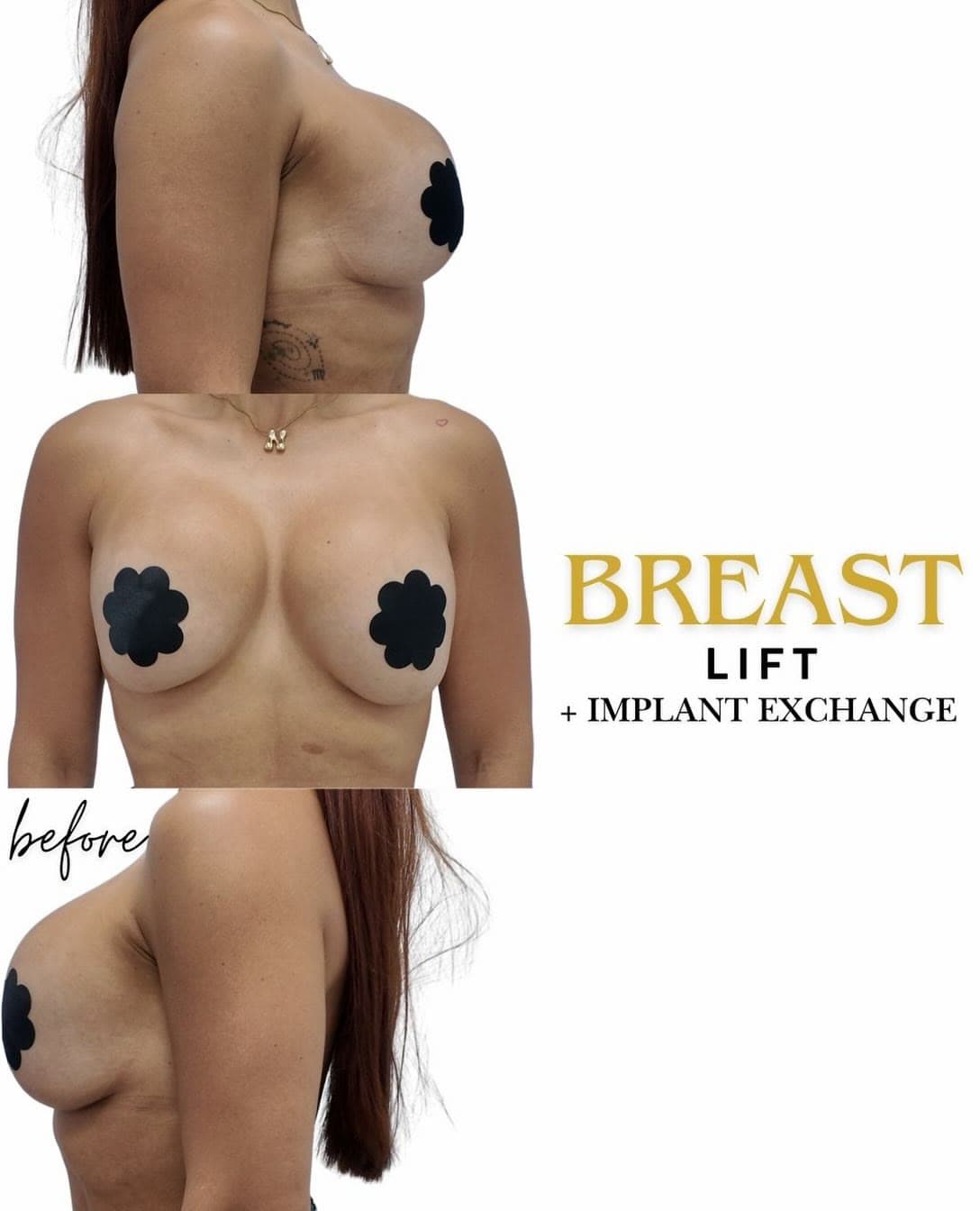 Breast Lift + Implant Exchange before and after: the patient before surgery and after surgery, Alluring Plastic Surgery, Miami