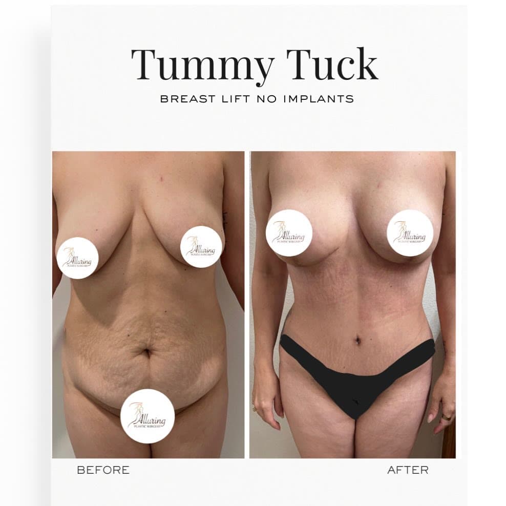 Extended Tummy Tuck + Breast Lift before and after 6 weeks post-op: the patient before surgery and after surgery, Alluring Plastic Surgery, Miami