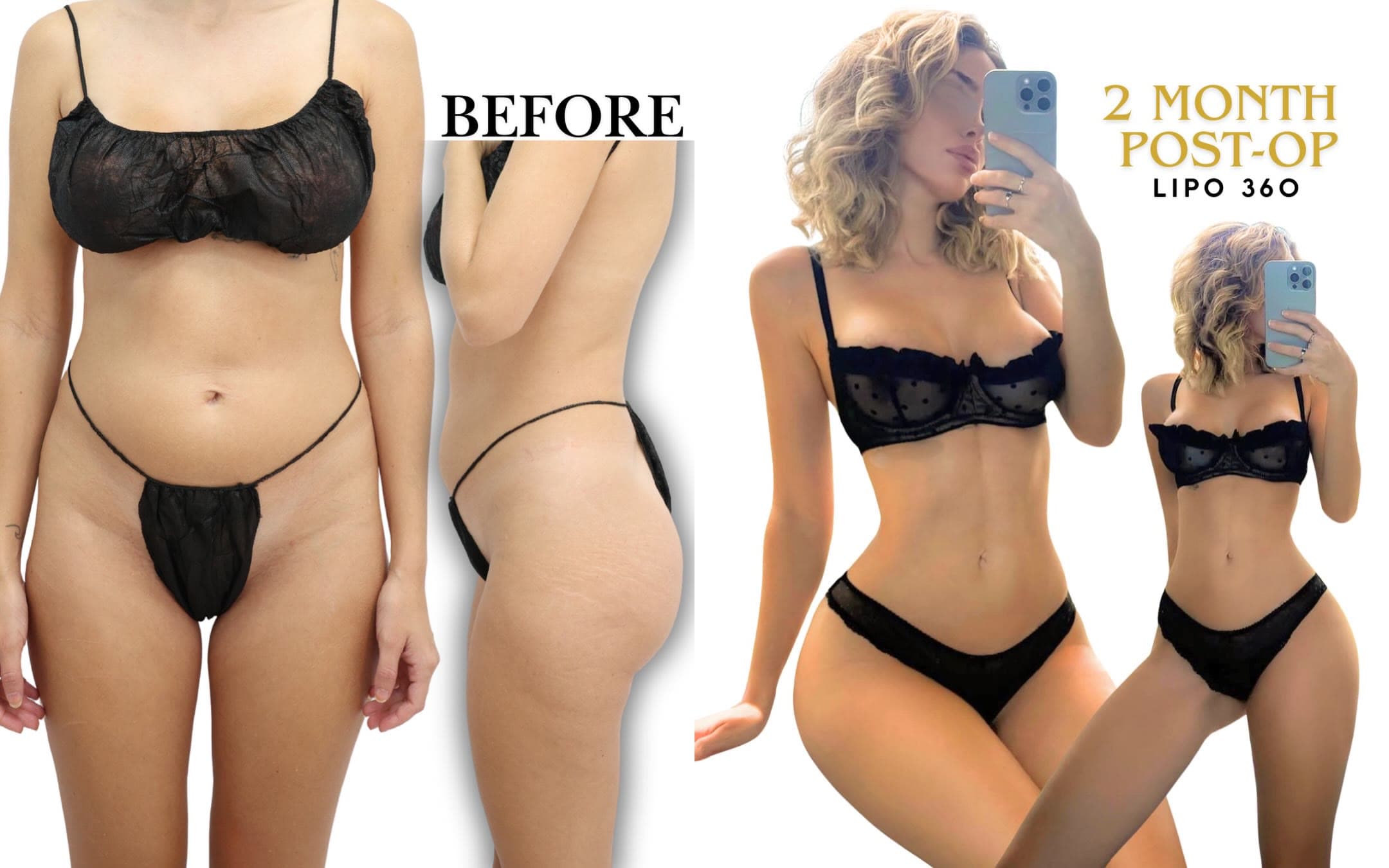 Lipo 360 before and after 2 months post-op: the patient before surgery and after surgery, Alluring Plastic Surgery, Miami
