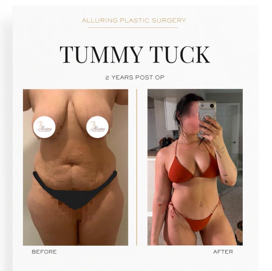 Tummy Tuck before and after 2 years post-op: the patient before surgery and after surgery, Alluring Plastic Surgery, Miami