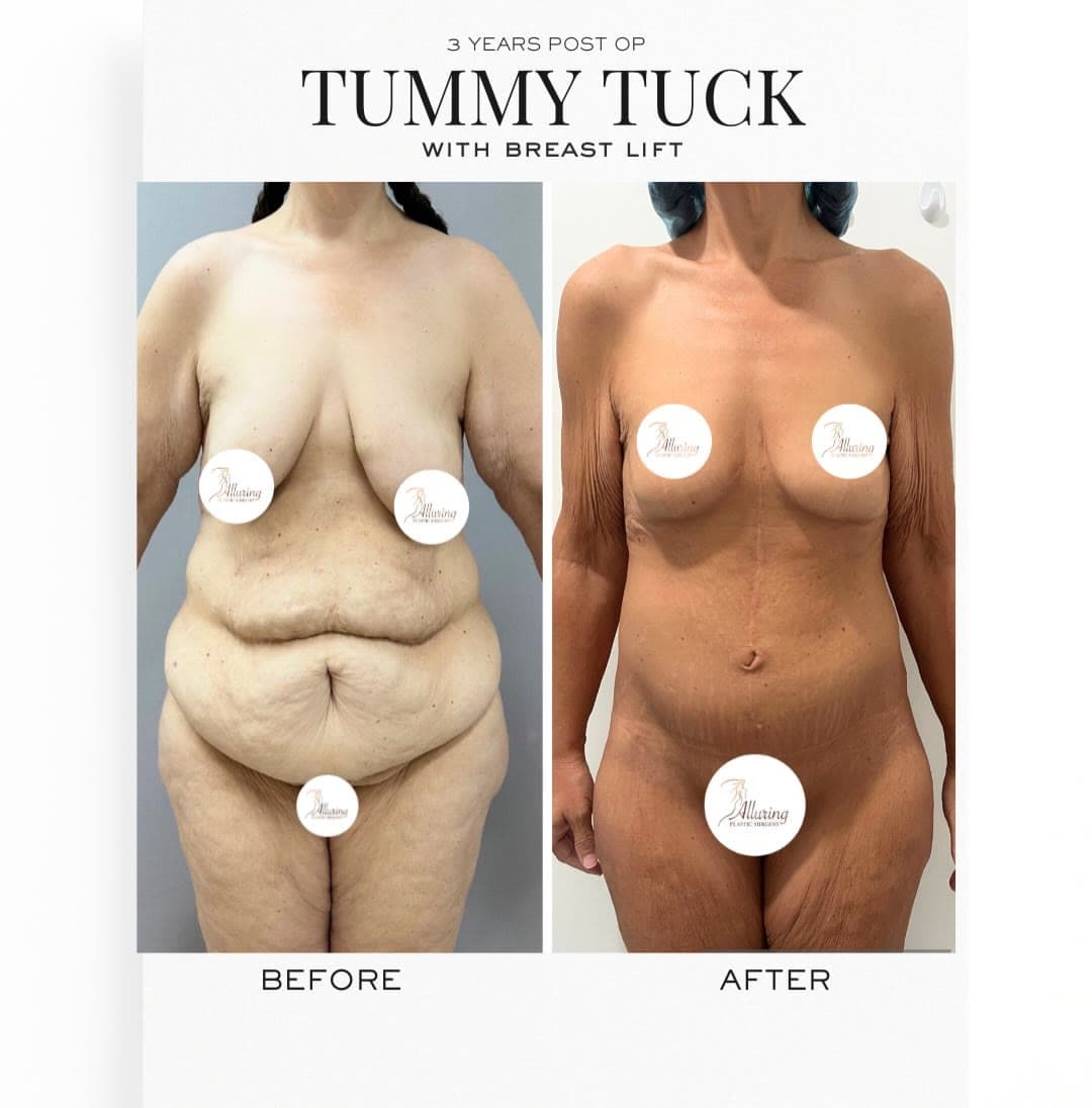 Tummy Tuck + Breast Lift before and after 3 years post-op: the patient before surgery and after surgery, Alluring Plastic Surgery, Miami