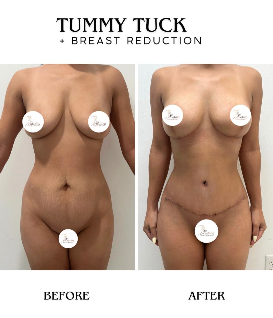 Tummy Tuck + Breast Reduction before and after 1 month post-op: the patient before surgery and after surgery, Alluring Plastic Surgery, Miami