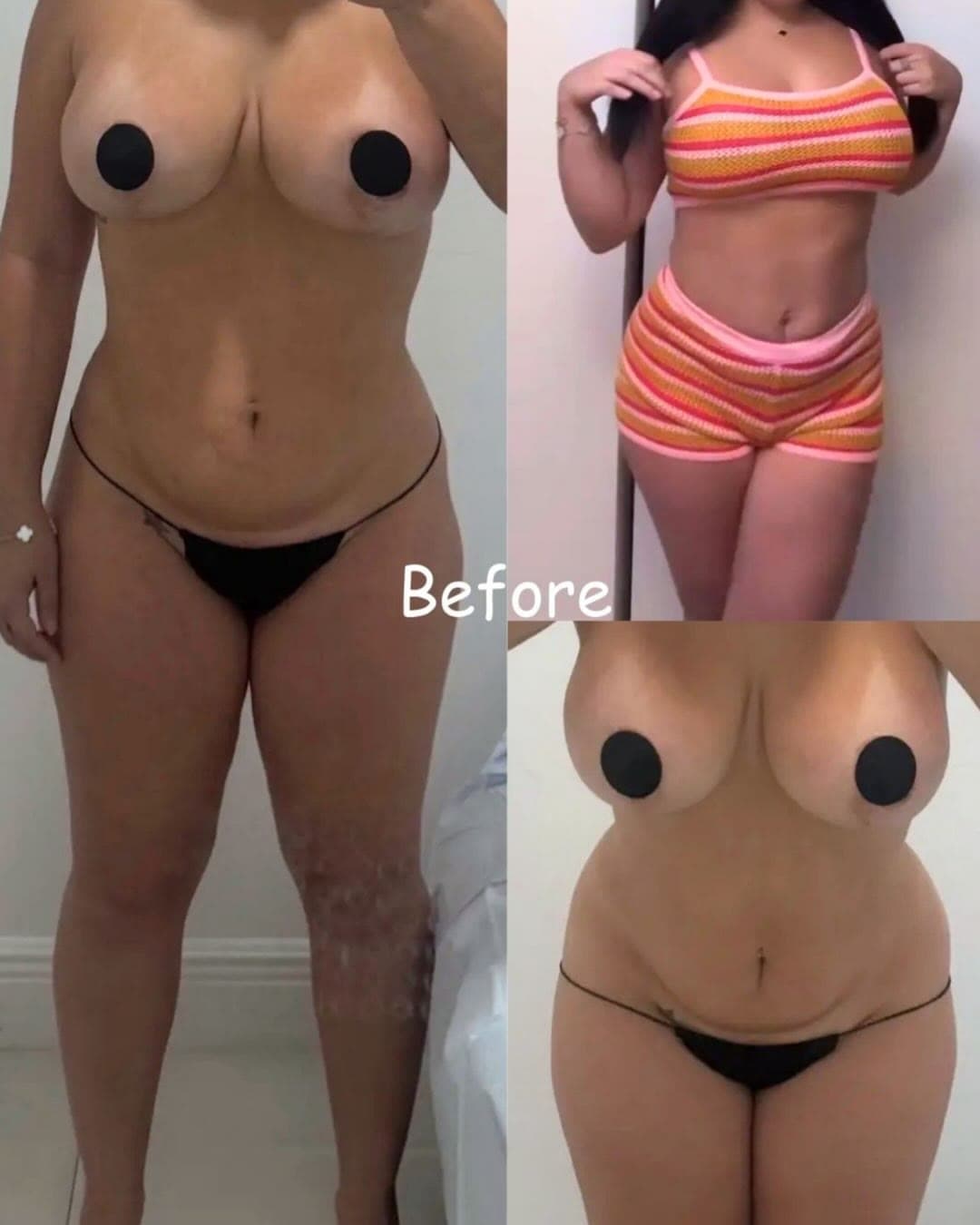 Tummy Tuck + Breast Reduction before and after 1 year post-op: the patient before surgery and after surgery, Alluring Plastic Surgery, Miami
